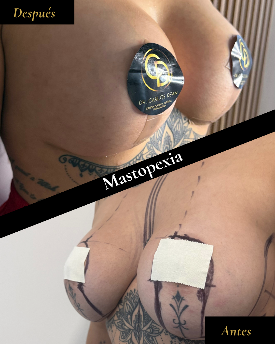 Resultado antes y después · caso 1